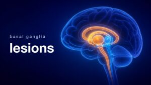 大脳基底核の核群が発光する脳のイラストと、脳幹へ下る2本の経路（basal ganglia lesions）